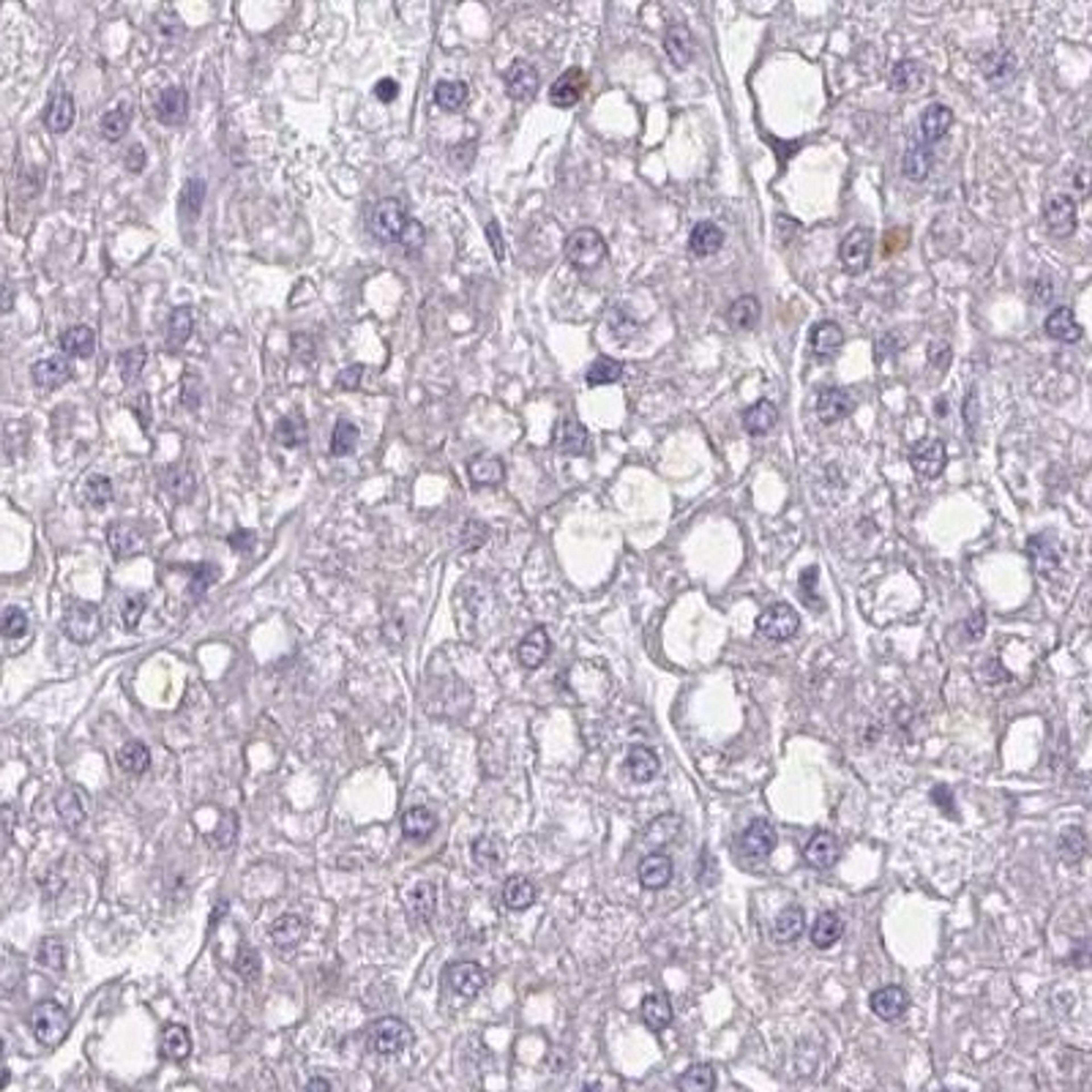 Immunohistochemistry: RTBDN Antibody [NBP2-31610] - liver cancer