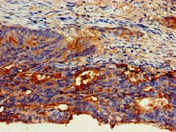 Immunohistochemistry of paraffin-embedded human colon cancer using CSB-PA005166LA01HU at dilution of 1:100