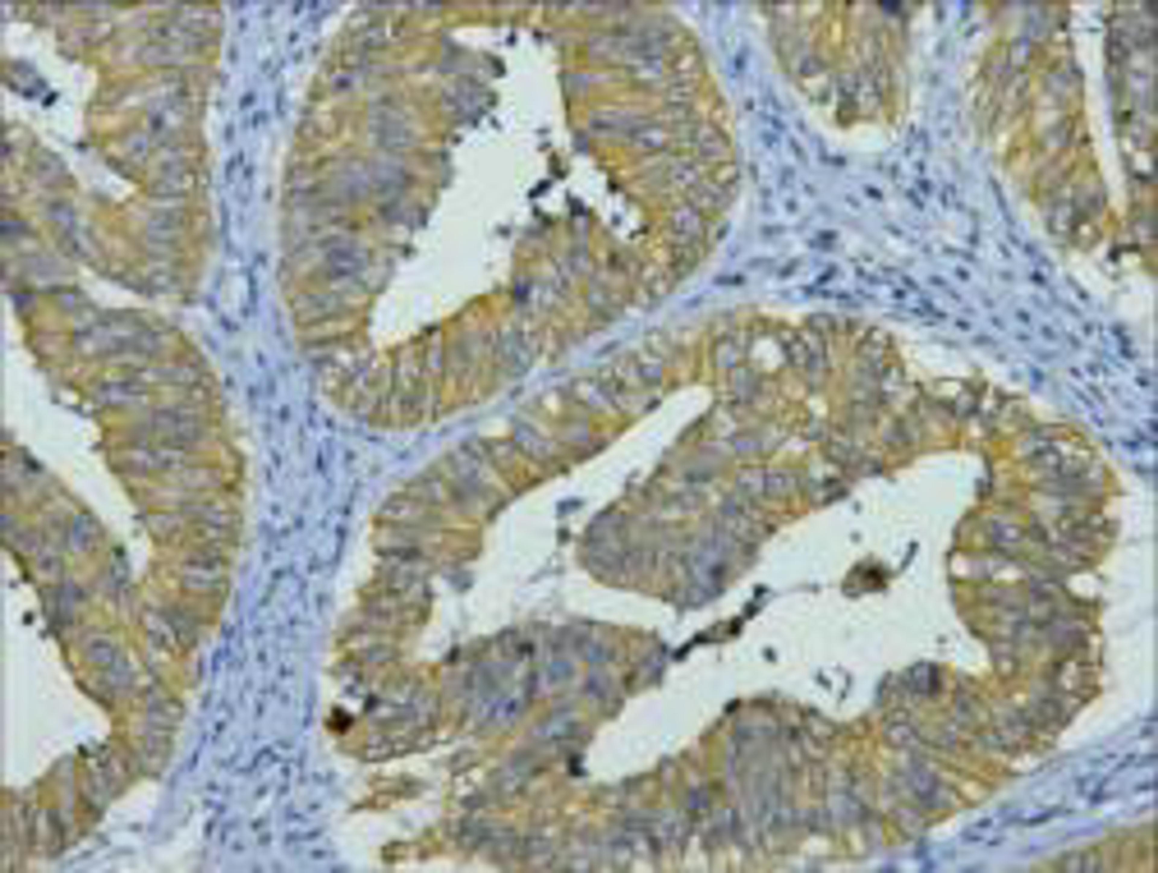 IHC staining of human colon cancer tissue, diluted at 1:200.