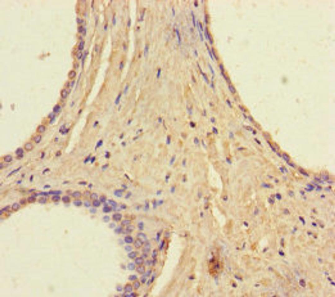 Immunohistochemistry of paraffin-embedded human prostate cancer using CSB-PA872547LA01HU at dilution of 1:100