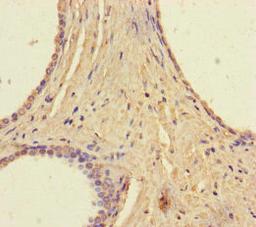 Immunohistochemistry of paraffin-embedded human prostate cancer using CSB-PA872547LA01HU at dilution of 1:100