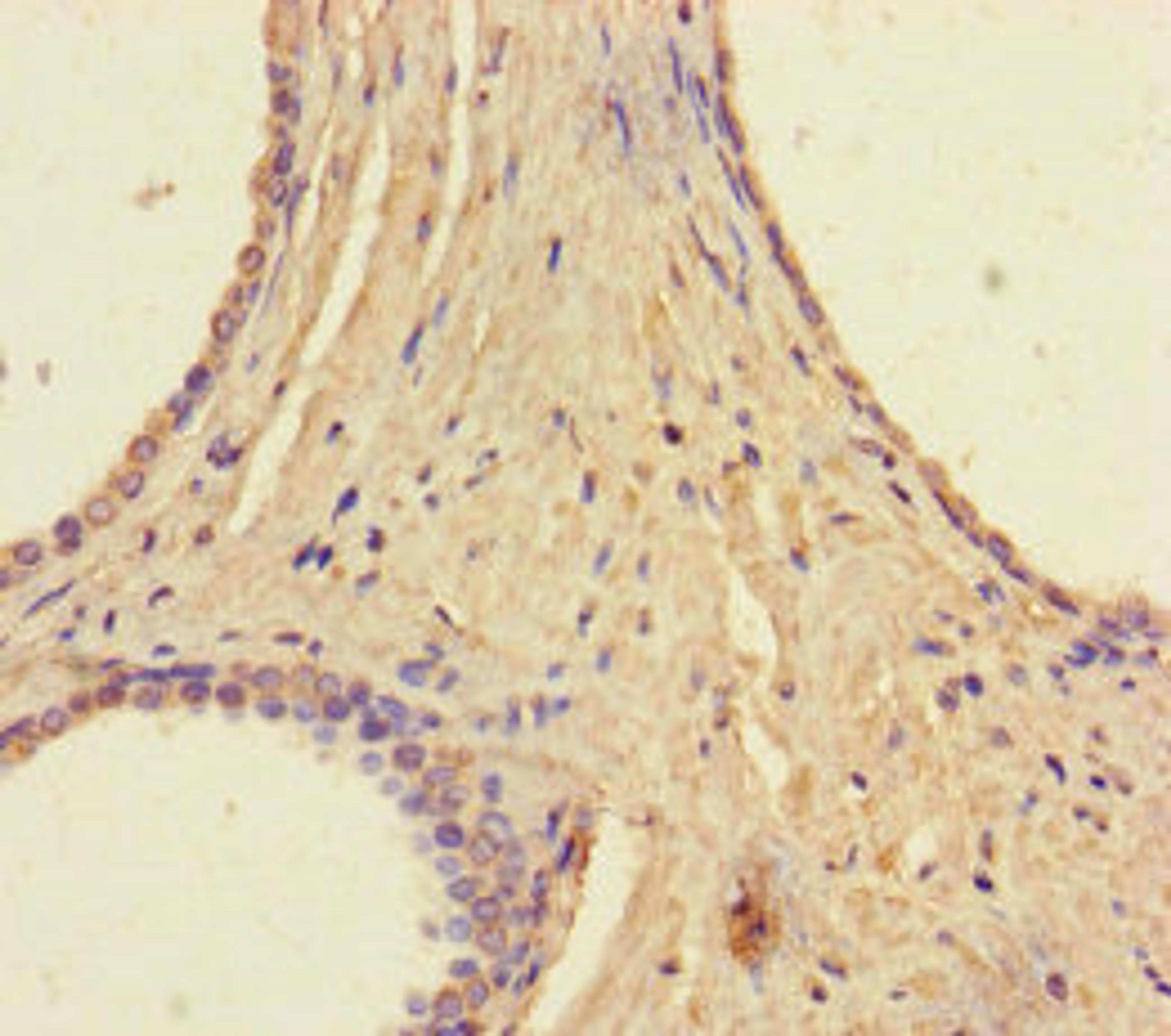 Immunohistochemistry of paraffin-embedded human prostate cancer using CSB-PA872547LA01HU at dilution of 1:100