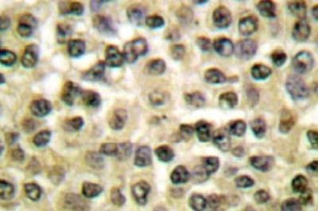 Immunohistochemistry: Ran Antibody [NB100-91945] - Immunohistochemistry  (IHC)  analyzes of Ran Antibody in paraffin-embedded human breast carcinoma  tissue.