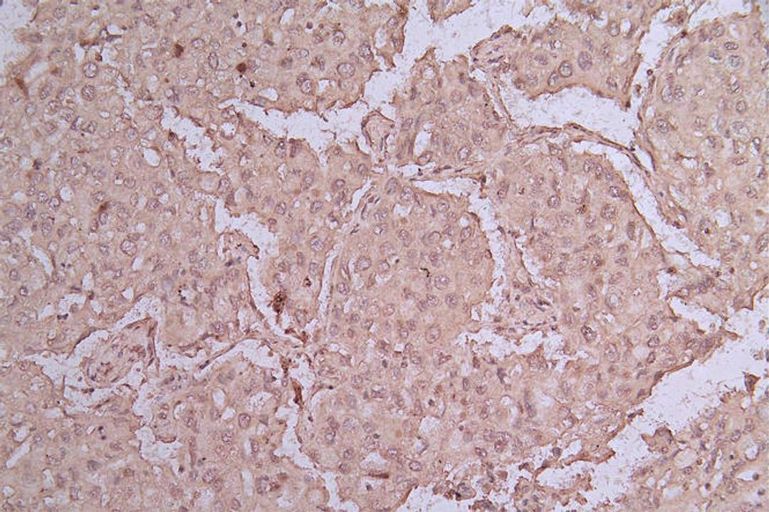 IHC image of CSB-RA159341MA1HU diluted at 1:50 and staining in paraffin-embedded human lung cancer performed on a Leica BondTM system. After dewaxing and hydration, antigen retrieval was mediated by high pressure in a citrate buffer (pH 6.0). Section was blocked with 10% normal goat serum 30min at RT. Then primary antibody (1% BSA) was incubated at 4°C overnight. The primary is detected by a Goat anti-rabbit polymer IgG labeled by HRP and visualized using 0.05% DAB.