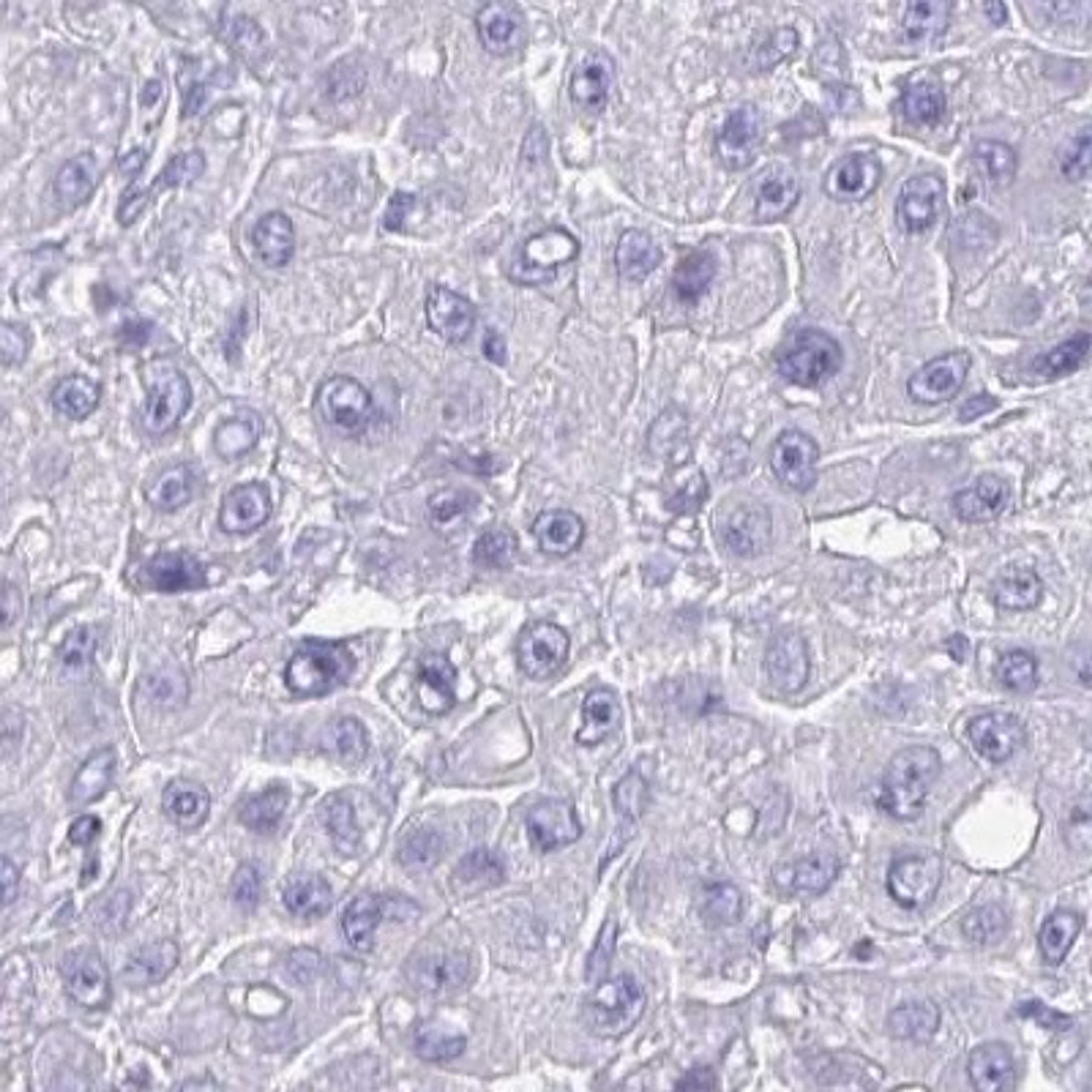 Immunohistochemistry: ZNF221 Antibody [NBP2-31768] - liver cancer