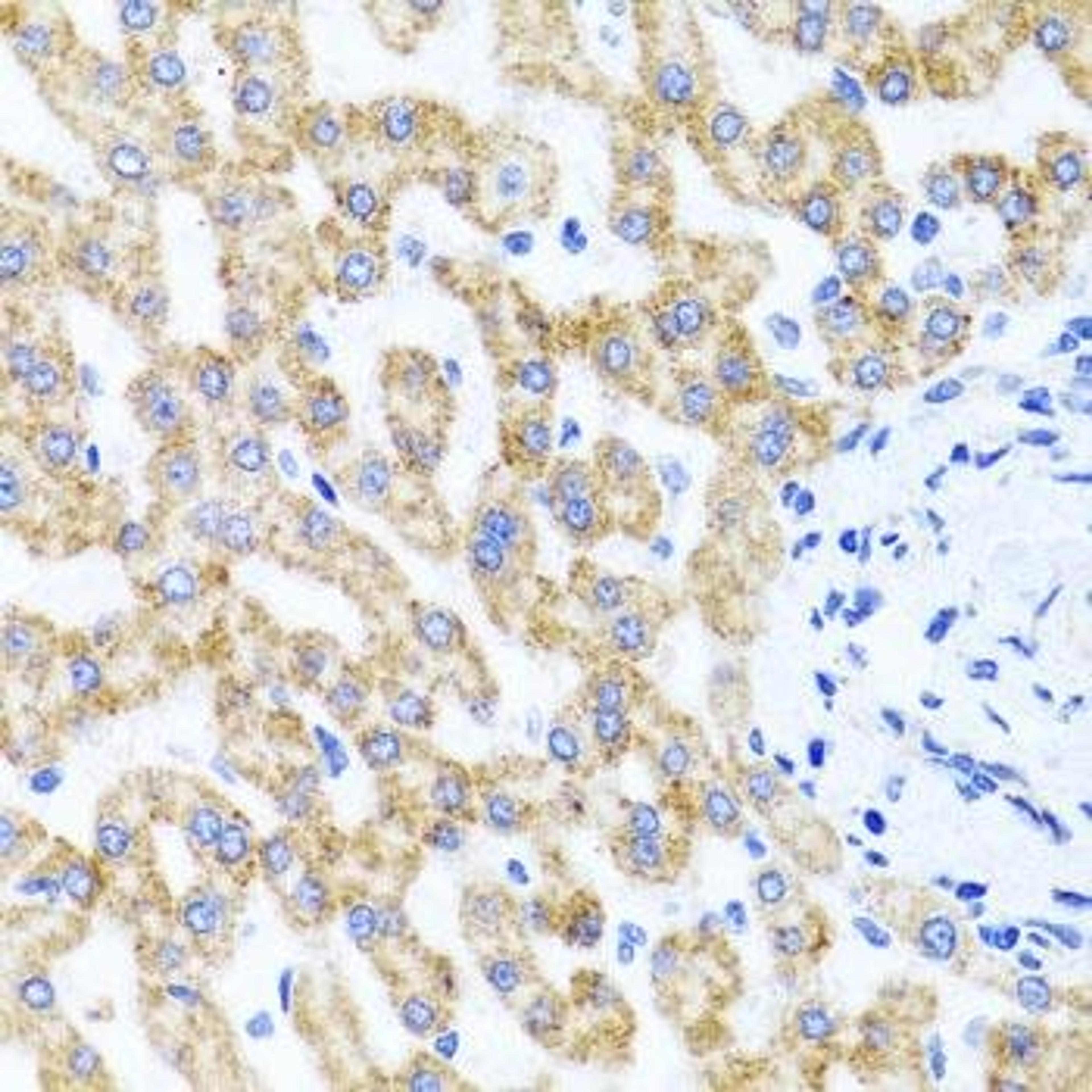 Immunohistochemical staining of human liver injury tissue using RIPK4 antibody (dilution of 1:100)