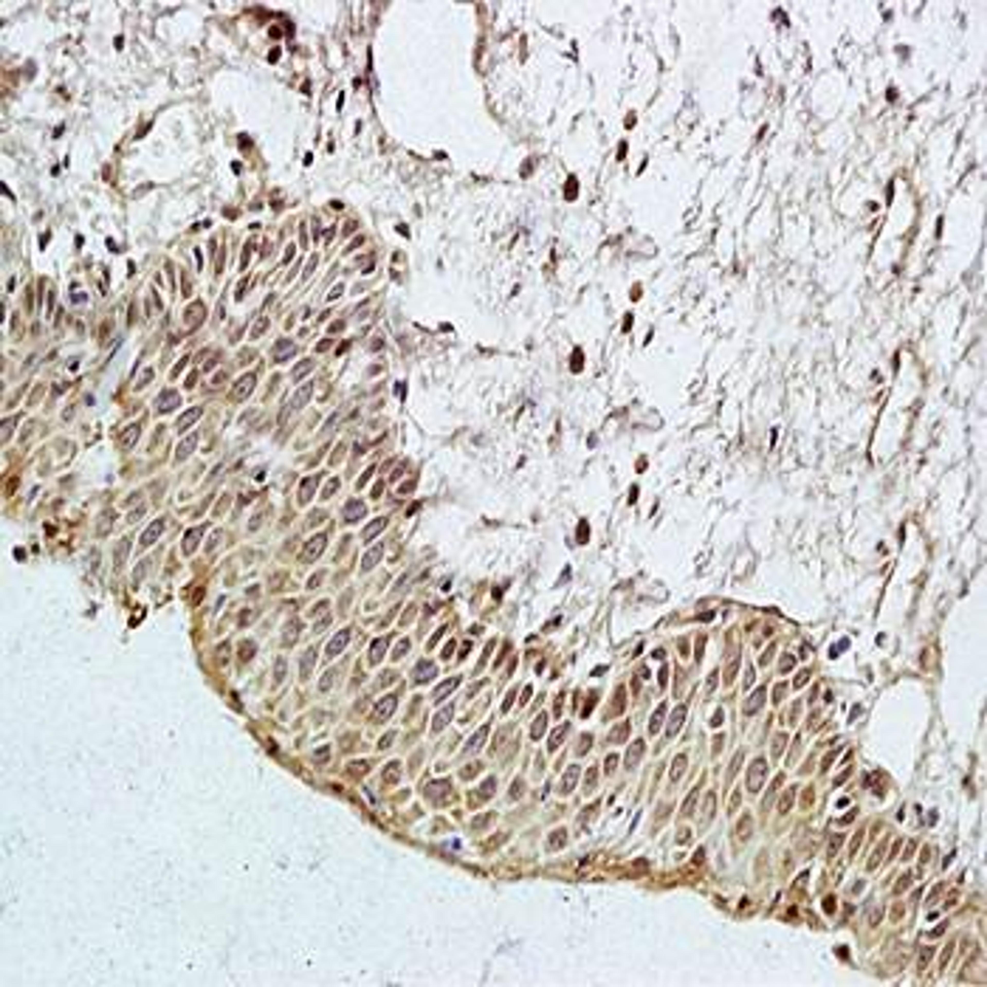 Immunohistochemical analysis of formalin-fixed and paraffin embedded human cervical cancer tissue (Dilution at:1:200) using PAR3 antibody