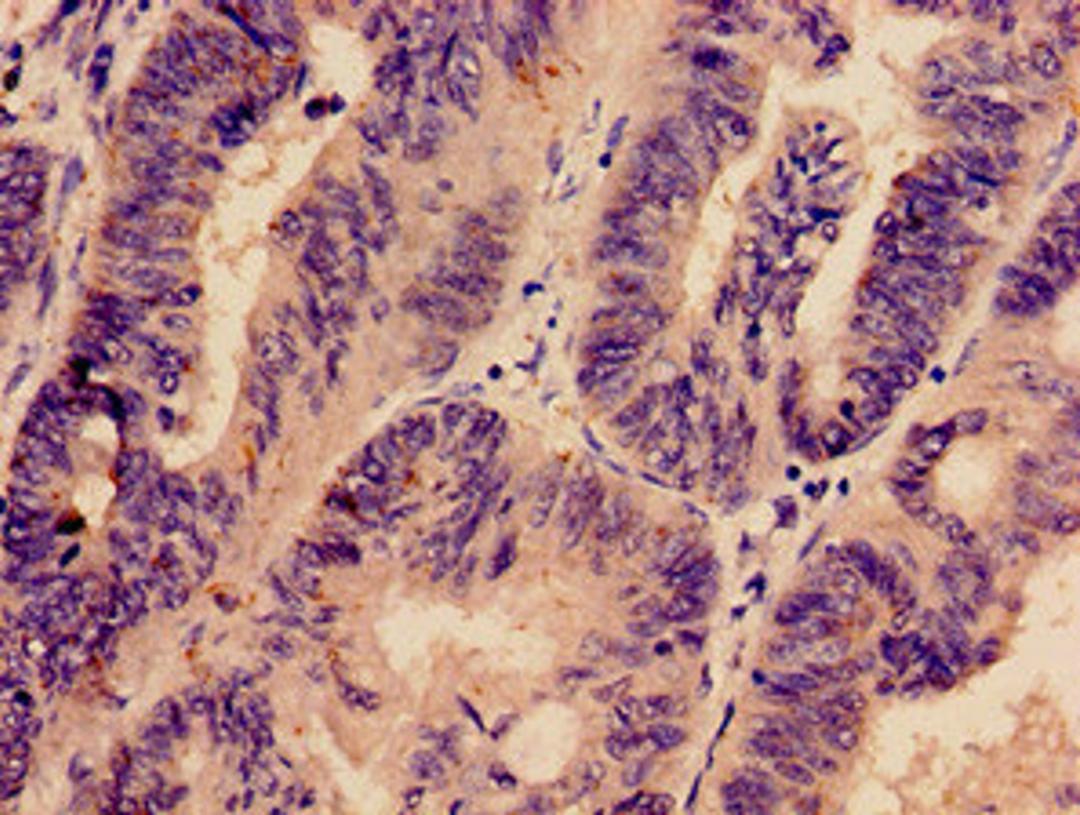 Immunohistochemistry analysis of human colon cancer using CSB-PA848403LA01HU at dilution of 1:100