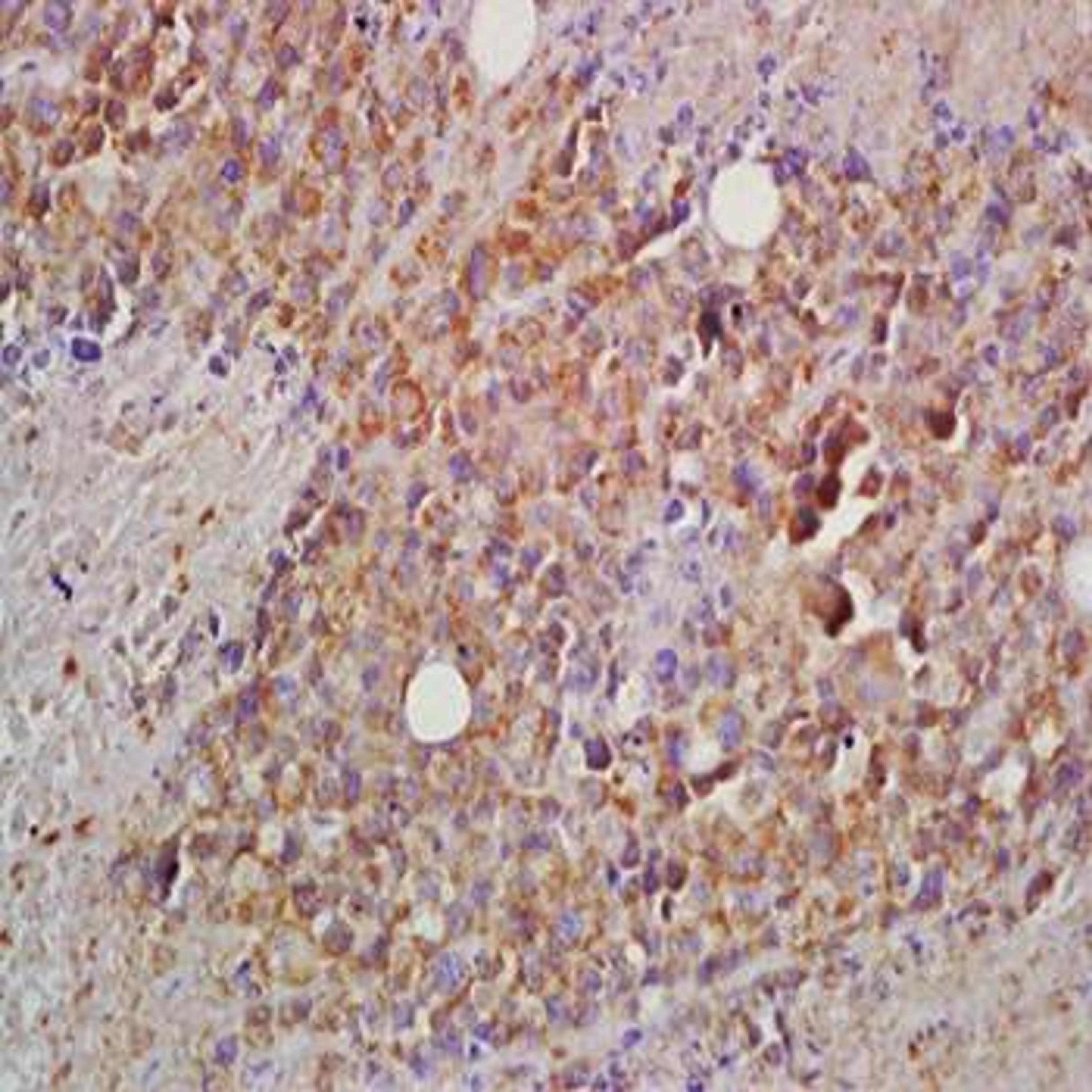 Immunohistochemical analysis of formalin-fixed and paraffin embedded mouse lymphoma tissue (Dilution at:1:200) using BCMA antibody