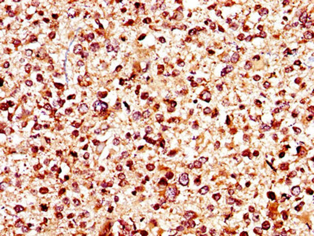 IHC image of CSB-PA012048LA01HU diluted at 1:400 and staining in paraffin-embedded human glioma performed on a Leica BondTM system. After dewaxing and hydration, antigen retrieval was mediated by high pressure in a citrate buffer (pH 6.0). Section was blocked with 10% normal goat serum 30min at RT. Then primary antibody (1% BSA) was incubated at 4&deg;C overnight. The primary is detected by a biotinylated secondary antibody and visualized using an HRP conjugated SP system.