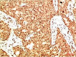 Immunohistochemical analysis of paraffin-embedded Human Breast Carcinoma Tissue using Acetyl NF kB P65(K314/K315)  Mouse mAb diluted at 1:200.