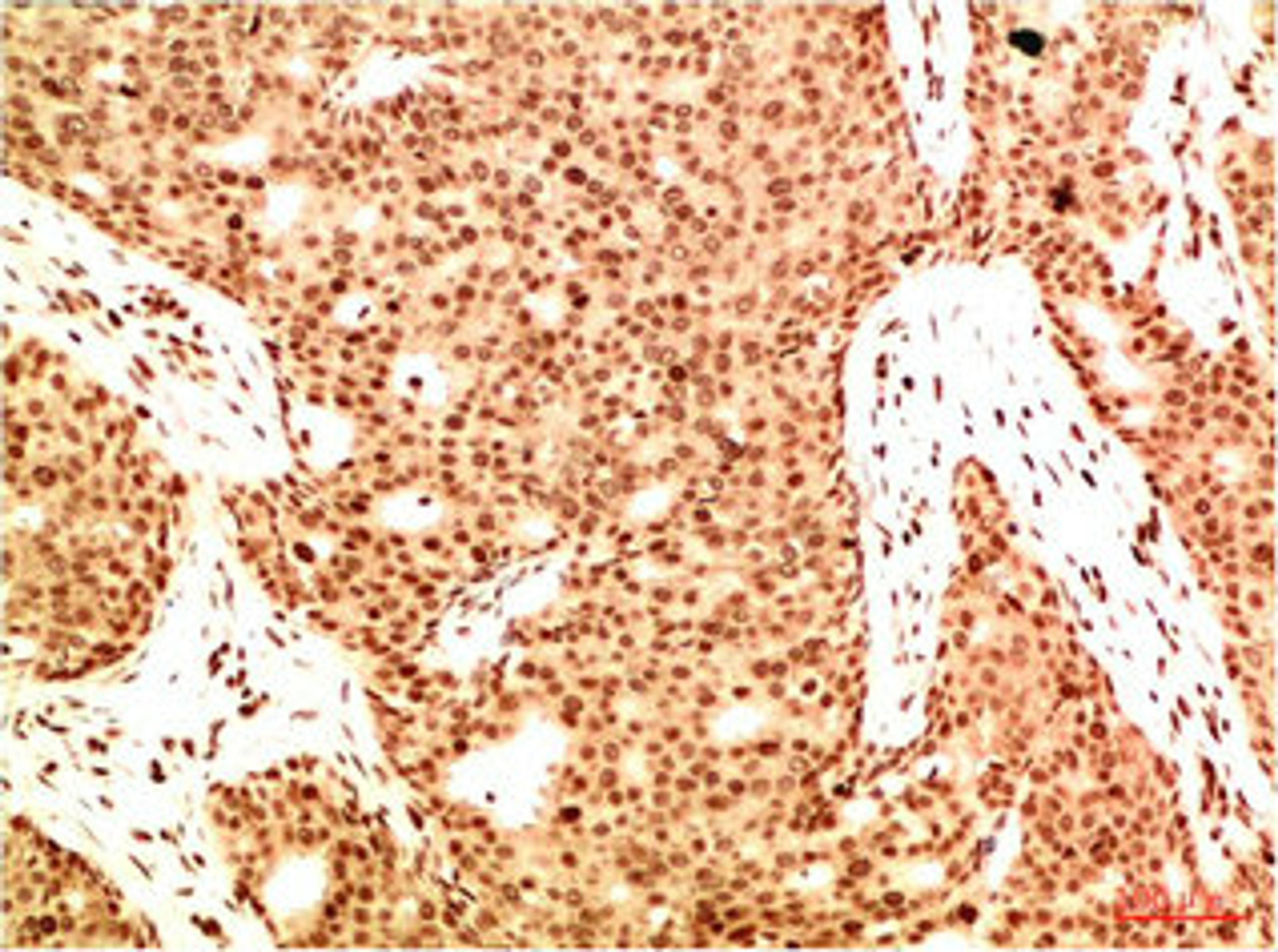 Immunohistochemical analysis of paraffin-embedded Human Breast Carcinoma Tissue using Acetyl NF kB P65(K314/K315)  Mouse mAb diluted at 1:200.