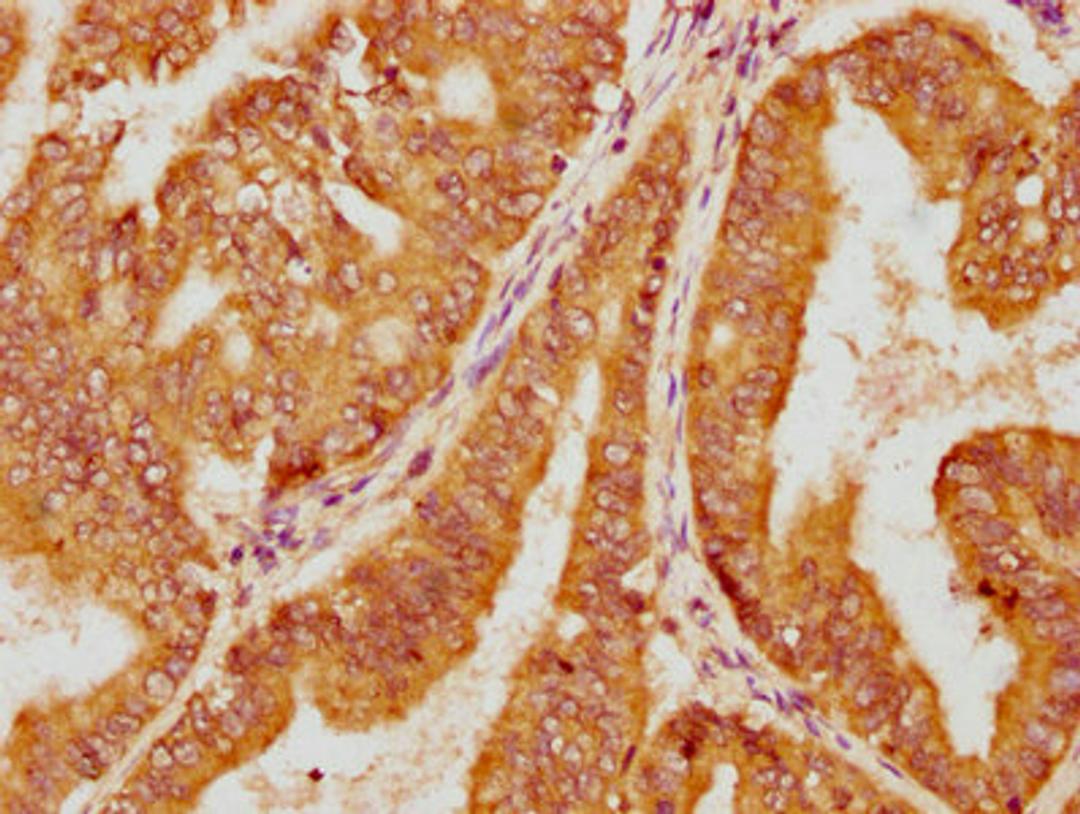 IHC image of CSB-PA622993LA01HU diluted at 1:100 and staining in paraffin-embedded human endometrial cancer performed on a Leica BondTM system. After dewaxing and hydration, antigen retrieval was mediated by high pressure in a citrate buffer (pH 6.0). Section was blocked with 10% normal goat serum 30min at RT. Then primary antibody (1% BSA) was incubated at 4°C overnight. The primary is detected by a biotinylated secondary antibody and visualized using an HRP conjugated SP system.
