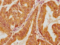 IHC image of CSB-PA622993LA01HU diluted at 1:100 and staining in paraffin-embedded human endometrial cancer performed on a Leica BondTM system. After dewaxing and hydration, antigen retrieval was mediated by high pressure in a citrate buffer (pH 6.0). Section was blocked with 10% normal goat serum 30min at RT. Then primary antibody (1% BSA) was incubated at 4°C overnight. The primary is detected by a biotinylated secondary antibody and visualized using an HRP conjugated SP system.