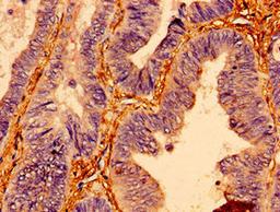 Immunohistochemistry of paraffin-embedded human colon cancer using CSB-PA01714A0Rb at dilution of 1:100