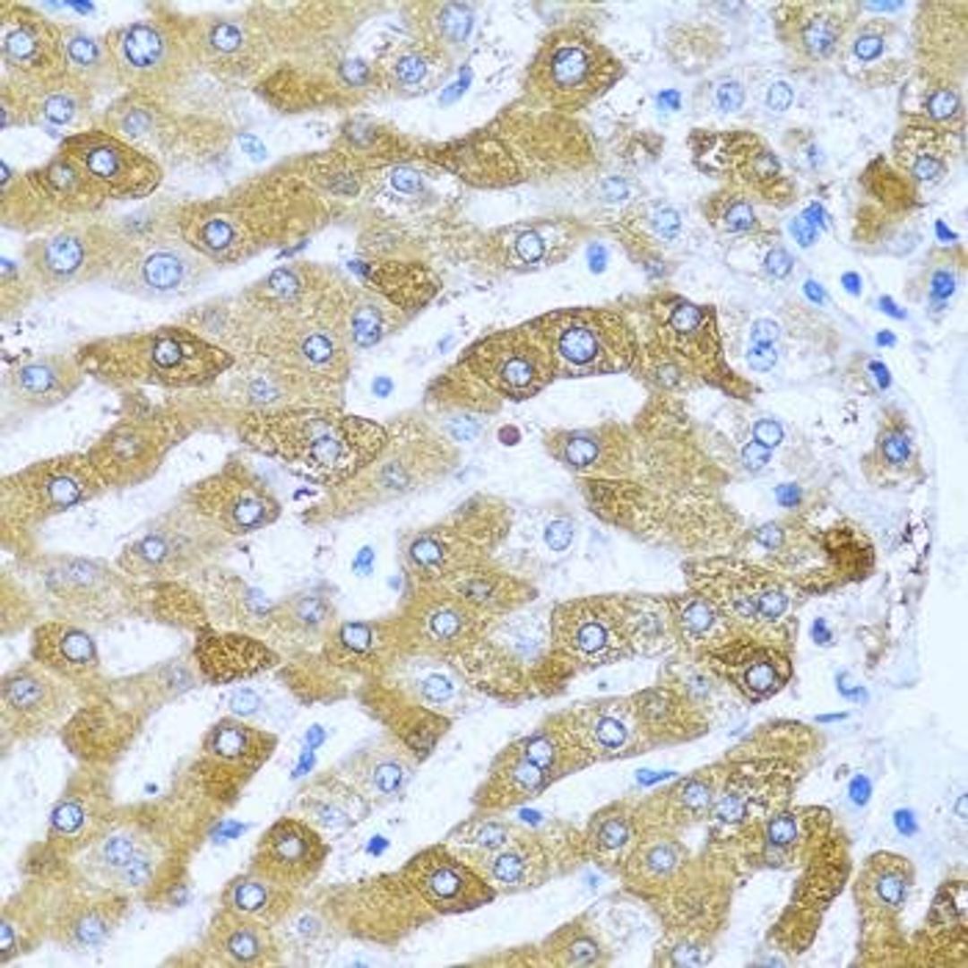 Immunohistochemical staining of human lung cancer tissue using IFIT3 antibody (dilution of 1:100)