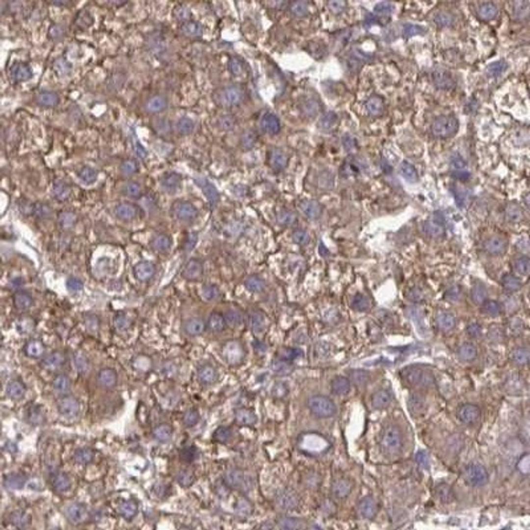 Immunohistochemistry: C12orf57 Antibody [NBP2-31752] - liver cancer