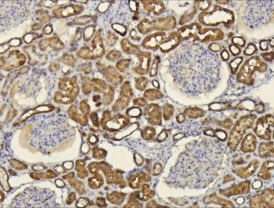 Immunohistochemistry-Paraffin: CXCL14/BRAK Antibody [NBP1-31398] -  Paraffin-embedded renal cell carcinoma, using antibody at 1:100 dilution.