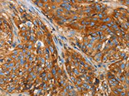 The image on the left is immunohistochemistry of paraffin-embedded Human esophagus cancer tissue using CSB-PA791042(B2M Antibody) at dilution 1/25, on the right is treated with fusion protein. (Original magnification: ×200)