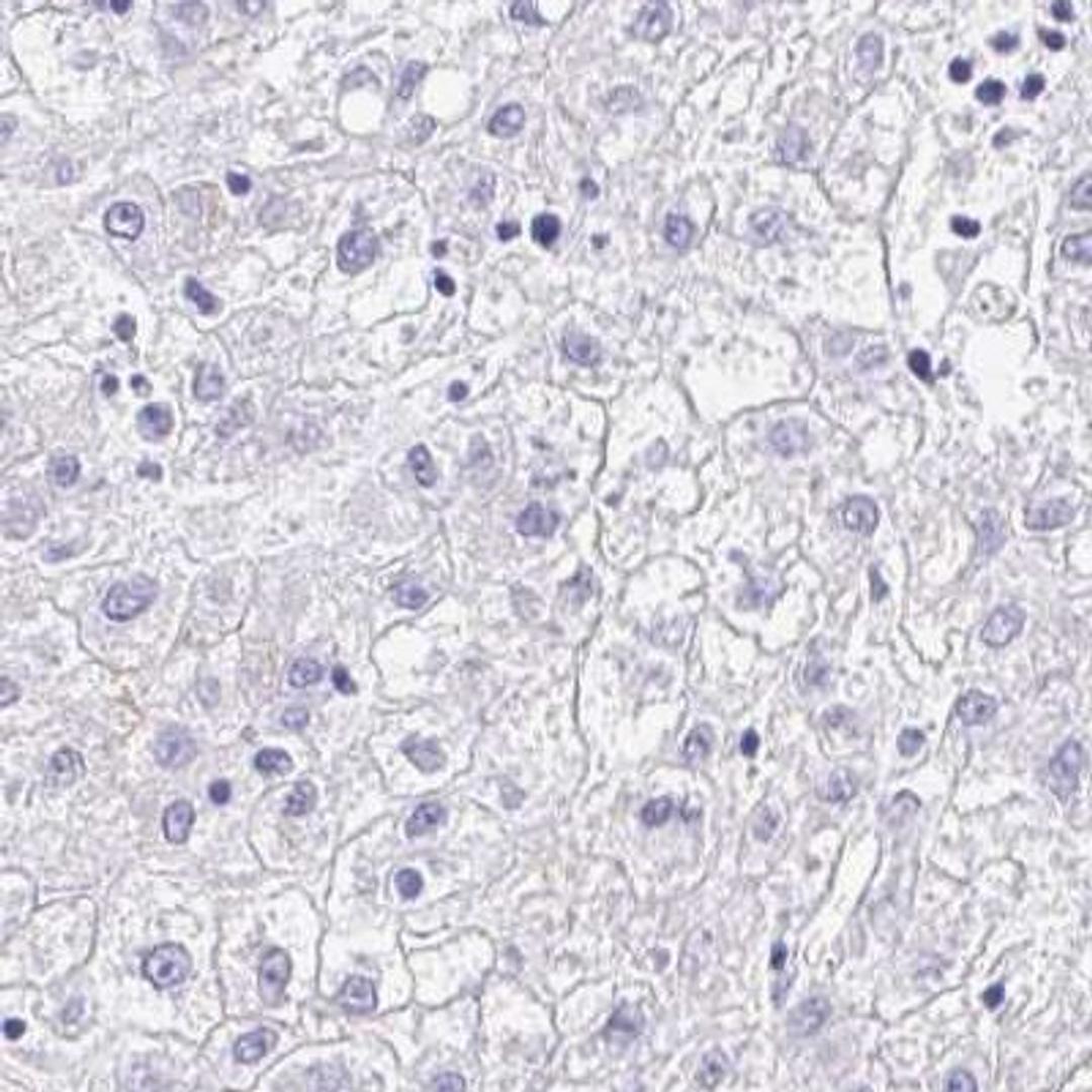 Immunohistochemistry: S100G Antibody [NBP2-31615] - liver cancer