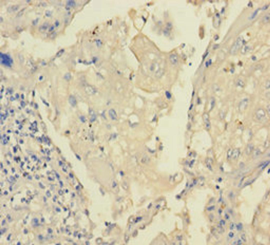 Immunohistochemistry of paraffin-embedded human lung cancer using CSB-PA768757LA01HU at dilution of 1:100