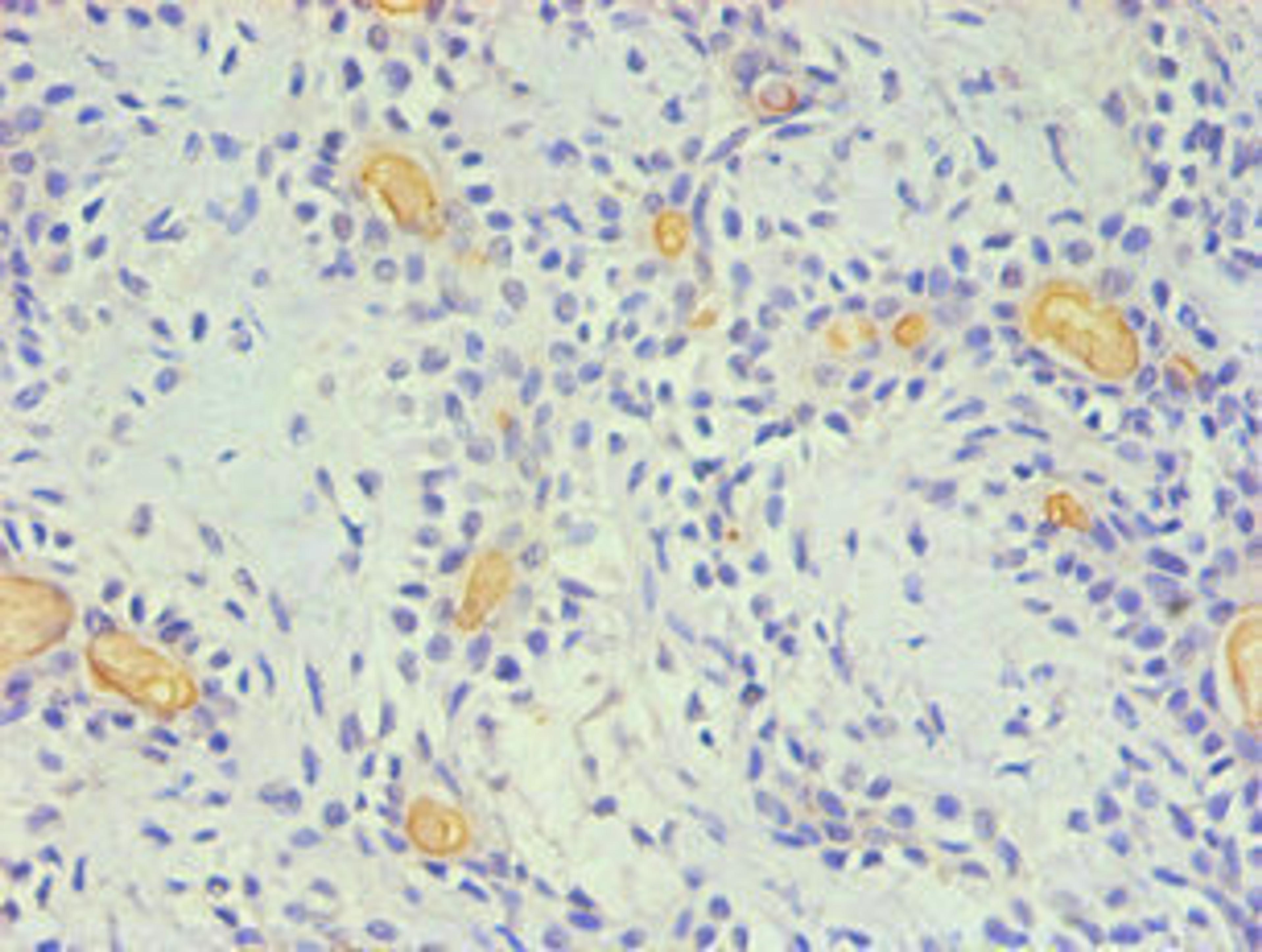 Immunohistochemical of paraffin-embedded Human breast cancer using CSB-MA0049471A0m (2E11-2B5) at dilution of 1:200.