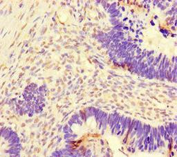 Immunohistochemistry of paraffin-embedded human ovarian cancer using CSB-PA615670LA01HU at dilution of 1:100