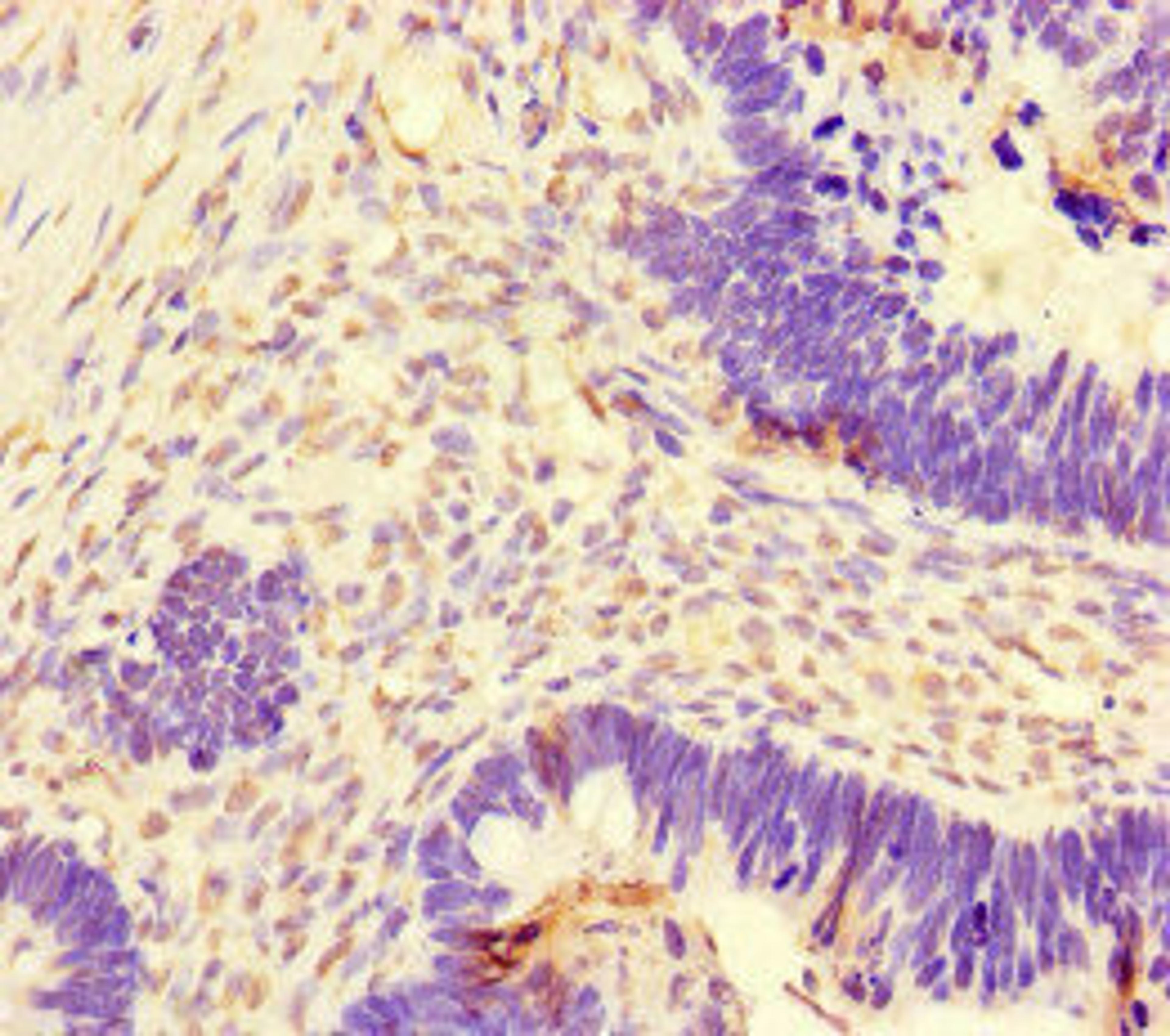 Immunohistochemistry of paraffin-embedded human ovarian cancer using CSB-PA615670LA01HU at dilution of 1:100