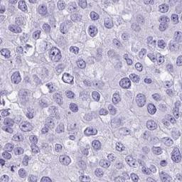 Immunohistochemistry: LCN15 Antibody [NBP2-32557] - breast cancer