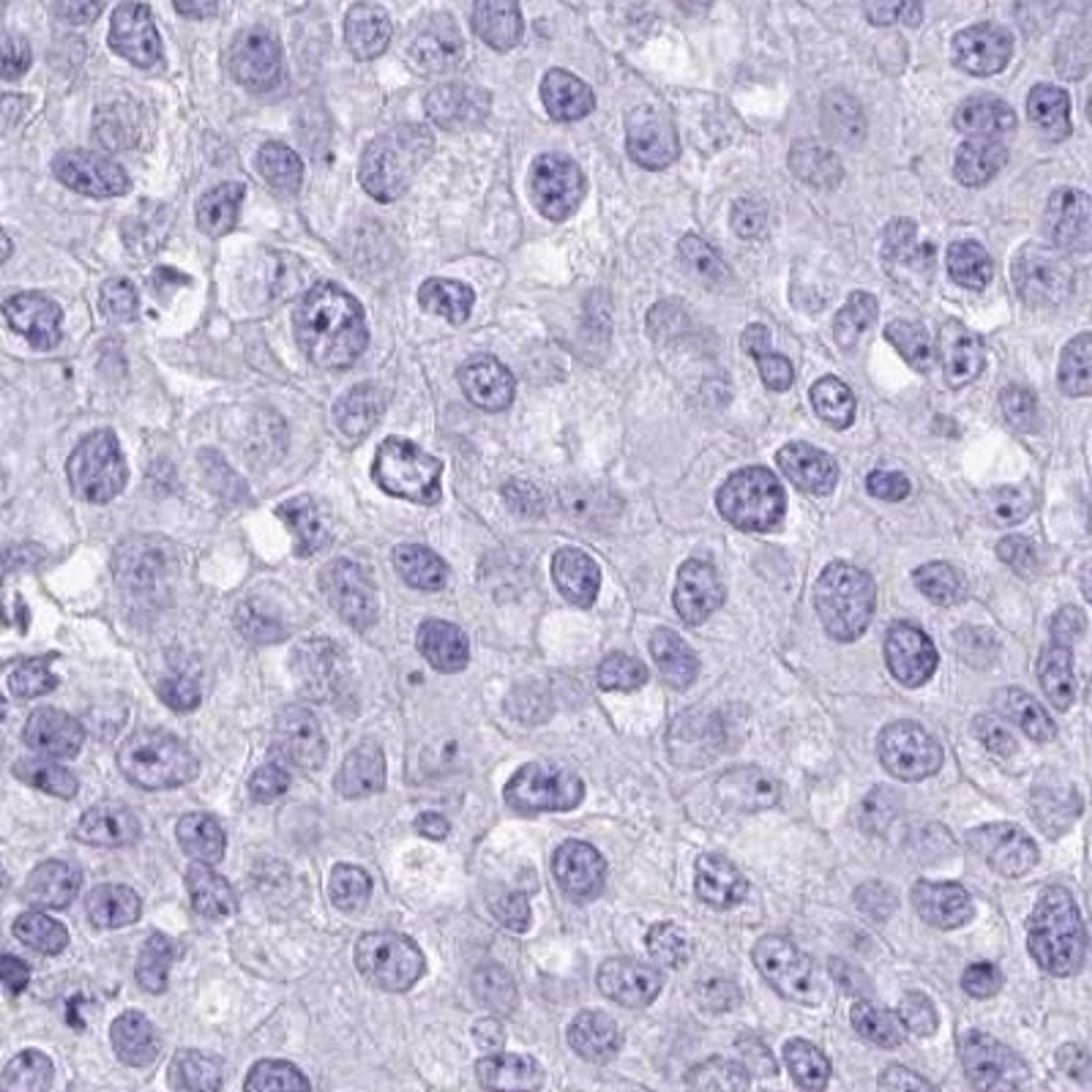 Immunohistochemistry: LCN15 Antibody [NBP2-32557] - breast cancer