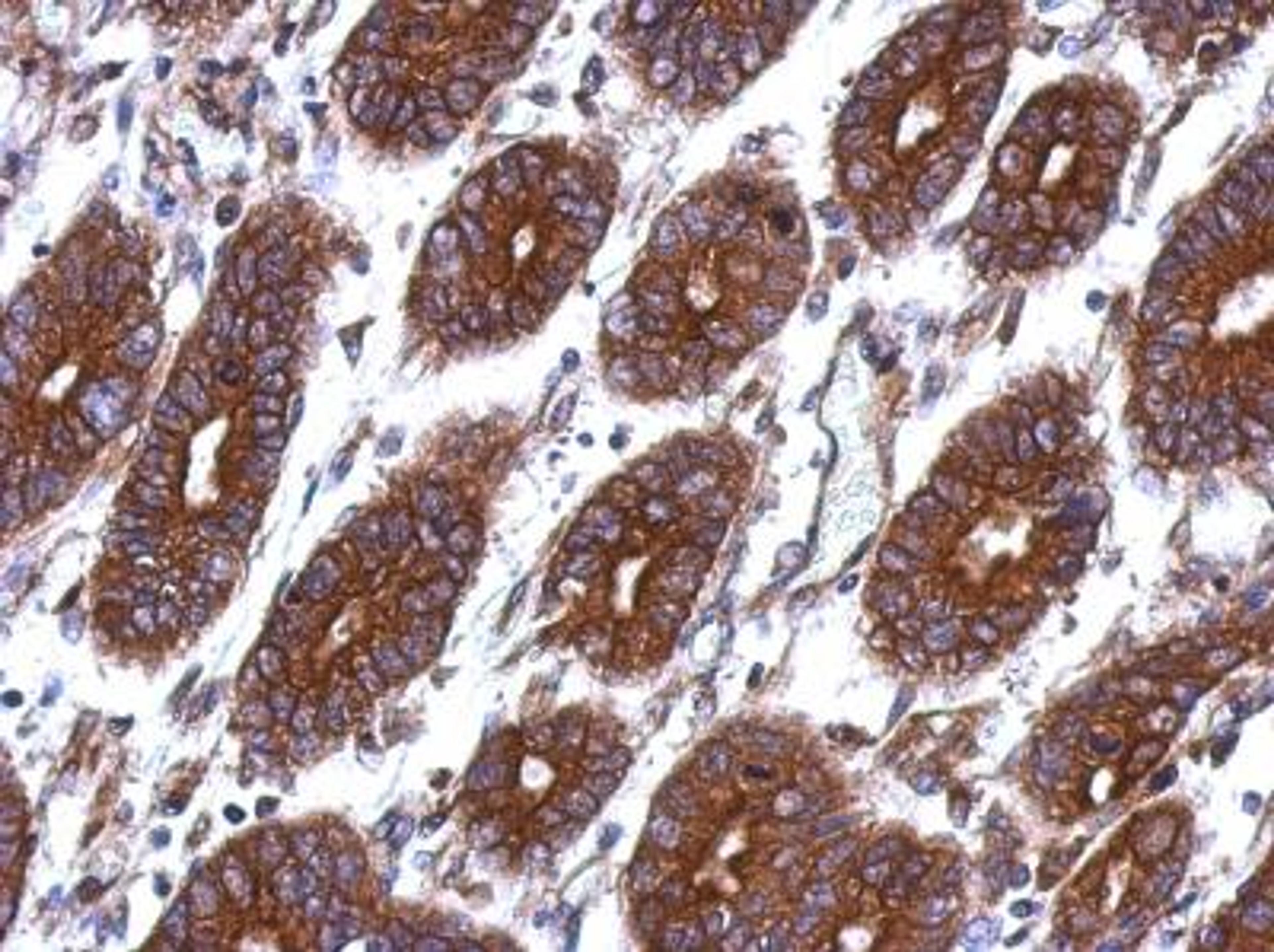 Immunohistochemistry-Paraffin: Thymidine Kinase 1 Antibody [NBP2-20626] - Immunohistochemical analysis of paraffin-embedded Colon cancer, using antibody at 1:500 dilution.