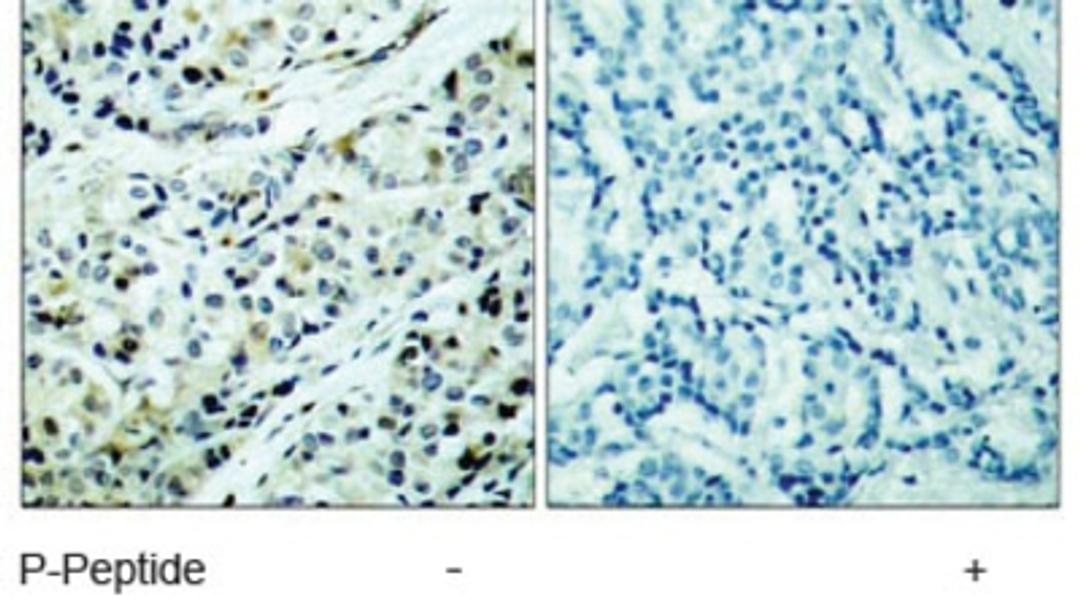 Immunohistochemistry: HDAC5 Phosphospecific Antibody [NB100-81953] - Immunohistochemical analysis of paraffin-embedded human breast carcinoma tissue, using HDAC5 (phospho-Ser498) antibody