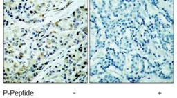 Immunohistochemistry: HDAC5 Phosphospecific Antibody [NB100-81953] - Immunohistochemical analysis of paraffin-embedded human breast carcinoma tissue, using HDAC5 (phospho-Ser498) antibody