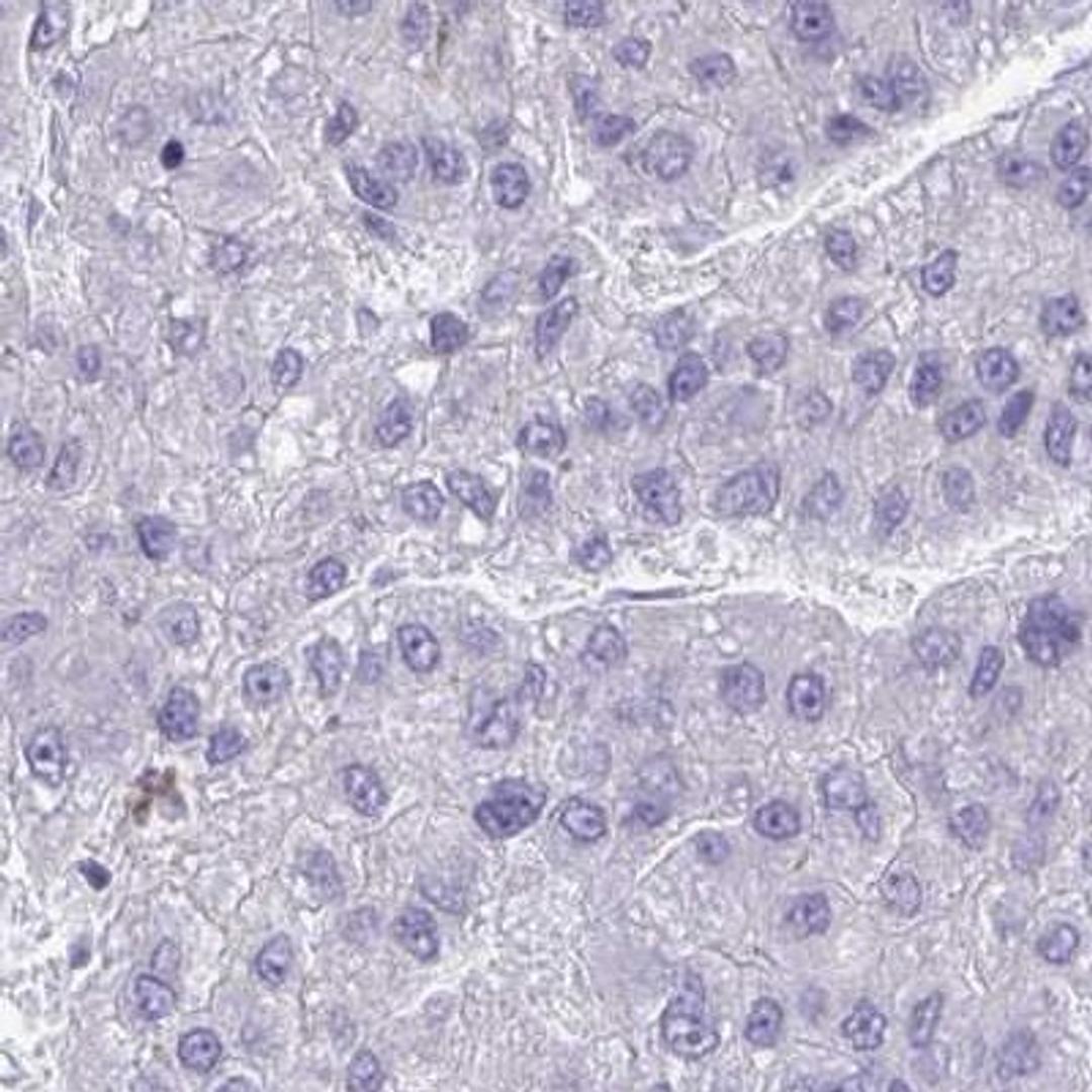 Immunohistochemistry: C19orf68 Antibody [NBP2-32584] - liver cancer