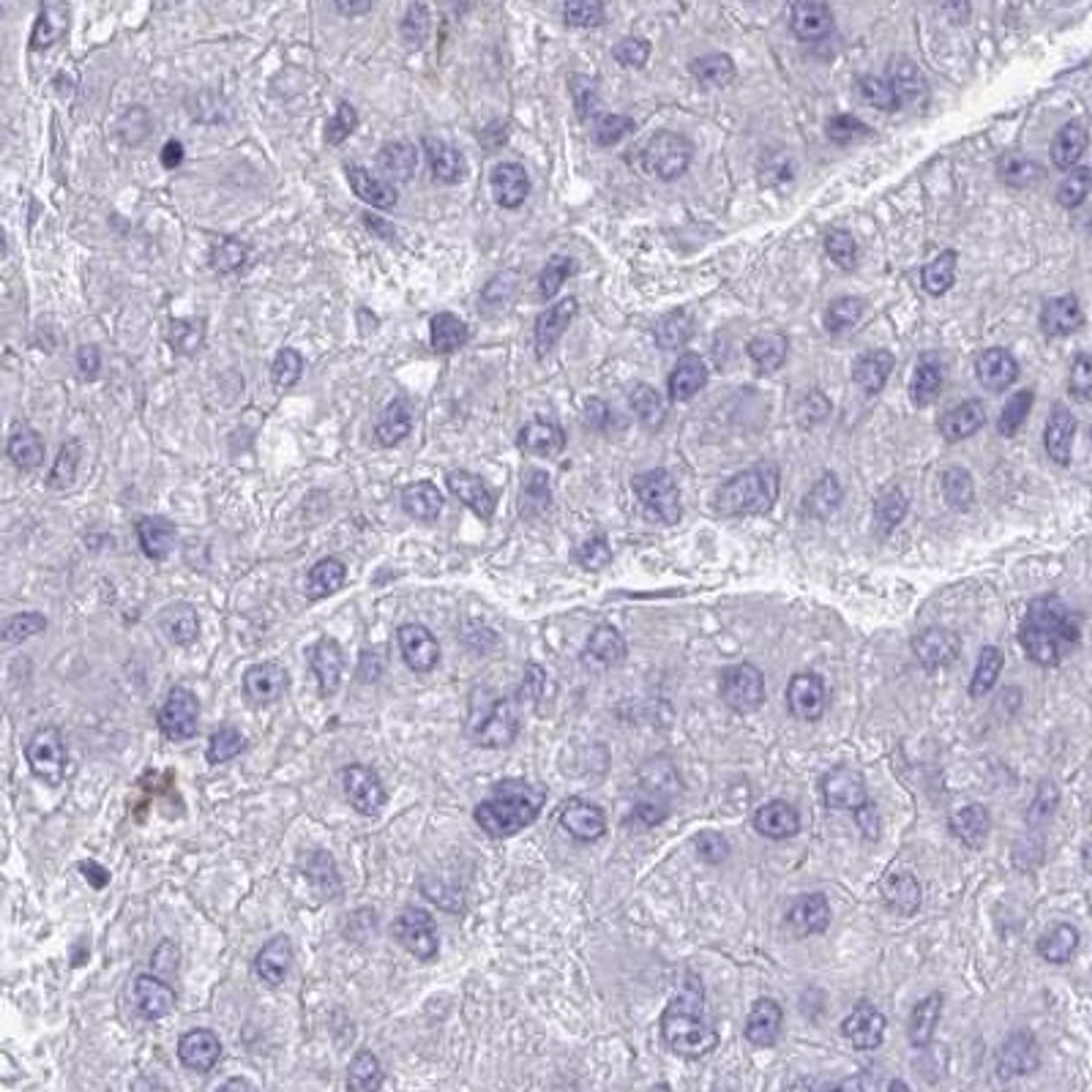 Immunohistochemistry: C19orf68 Antibody [NBP2-32584] - liver cancer