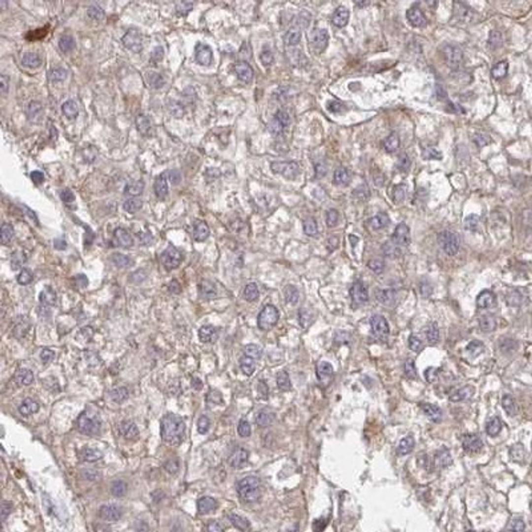 Immunohistochemistry: DCST1 Antibody [NBP2-31817] - liver cancer