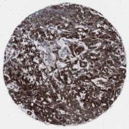 Immunohistochemistry: MYO5C Antibody [32190002] - Strong cytoplasmic and/or membranous staining pattern observed in colorectal cancer tissue by immunohistochemistry.  Image is provided courtesy of the Swedish Human Proteome Resource (HPR) Center.