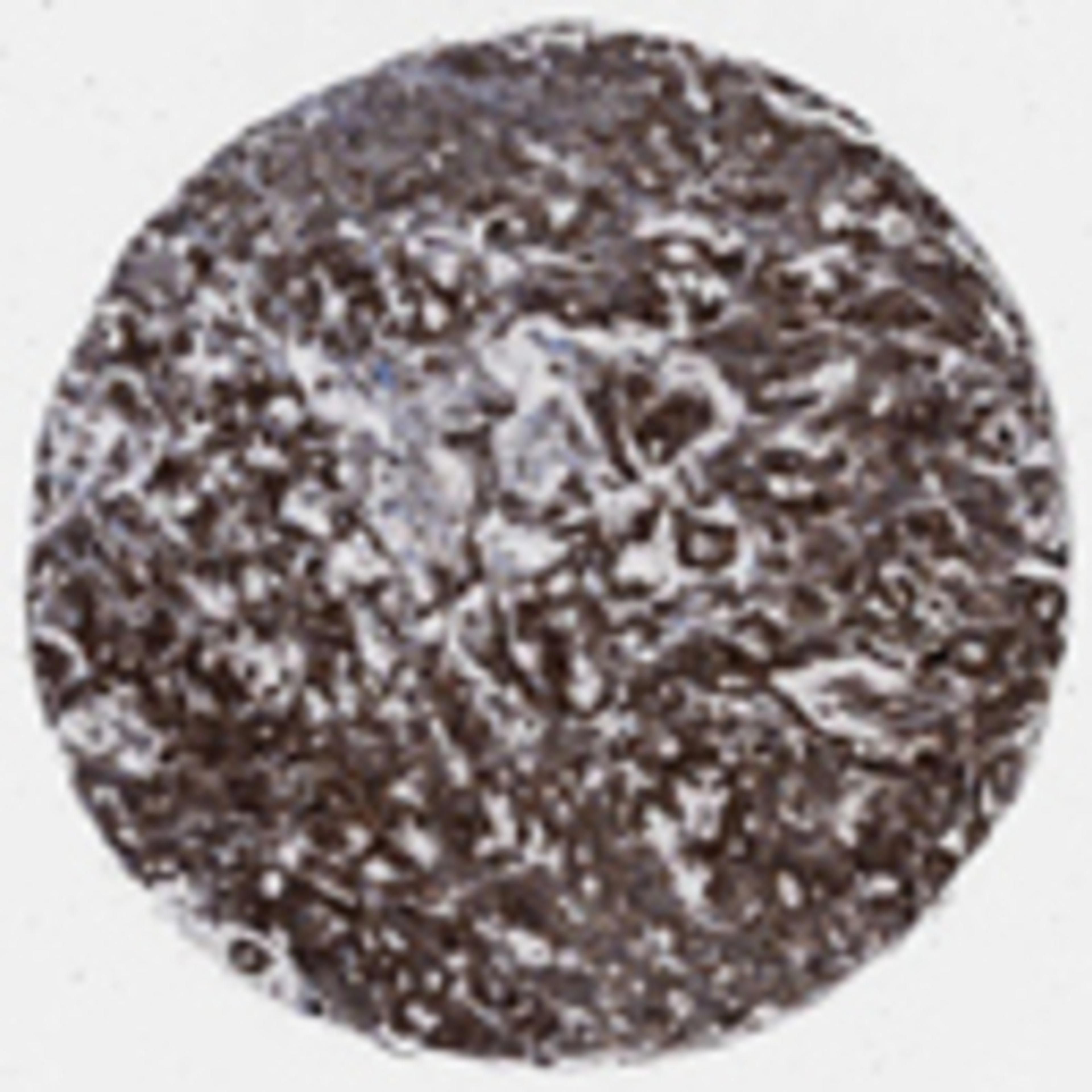 Immunohistochemistry: MYO5C Antibody [32190002] - Strong cytoplasmic and/or membranous staining pattern observed in colorectal cancer tissue by immunohistochemistry.  Image is provided courtesy of the Swedish Human Proteome Resource (HPR) Center.