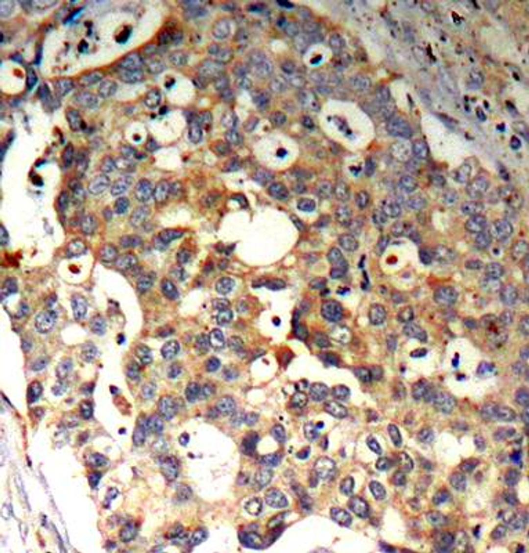 Immunohistochemical analysis of formalin-fixed and paraffin-embedded human breast carcinoma tissue using SAPK/JNK(Ab-183) antibody