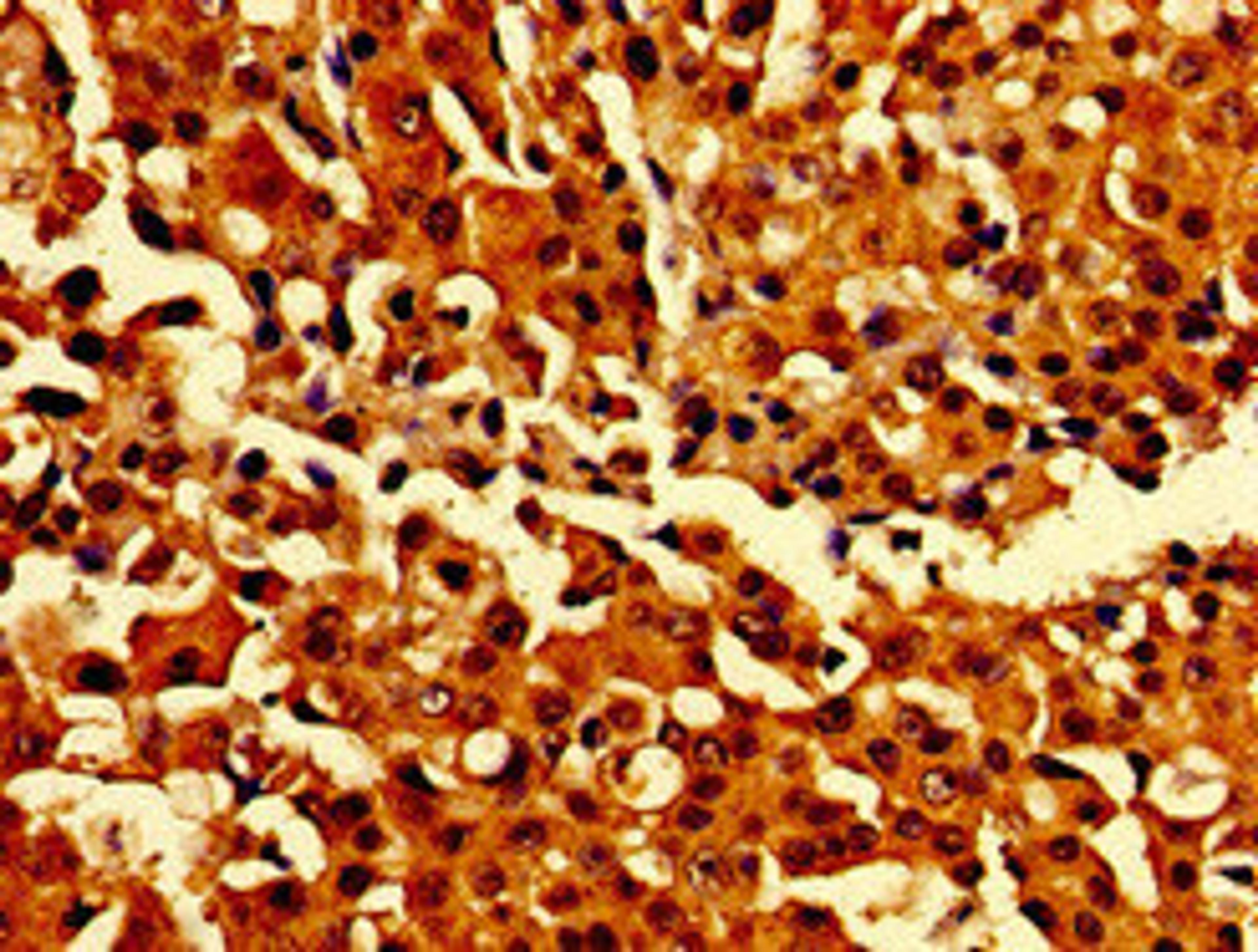 Immunohistochemistry of paraffin-embedded human breast cancer using CSB-PA883622LA01HU at dilution of 1:100