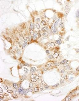 Immunohistochemistry-Paraffin: DOCK4 Antibody [NBP1-26648] - Human ovarian carcinoma. Antibody used at a dilution of 1:200 (1ug/ml).