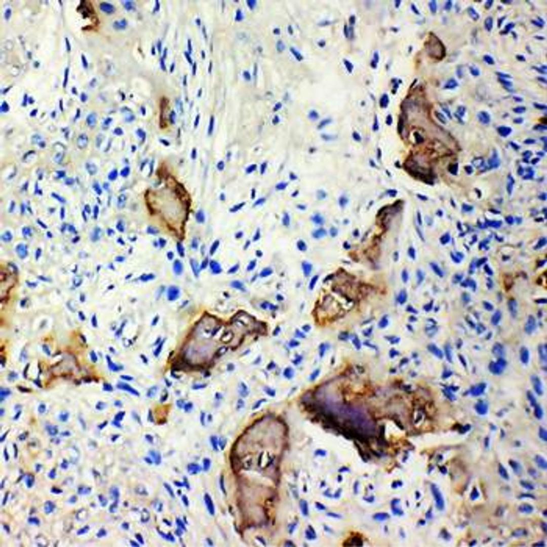 Immunohistochemical analysis of formalin-fixed and  paraffin embedded  human osteosarcoma tissue using IBSP antibody