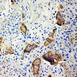 Immunohistochemical analysis of formalin-fixed and paraffin embedded human osteosarcoma tissue using IBSP antibody