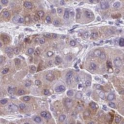 Immunohistochemistry: TMEM170A Antibody [NBP2-31593] - liver cancer