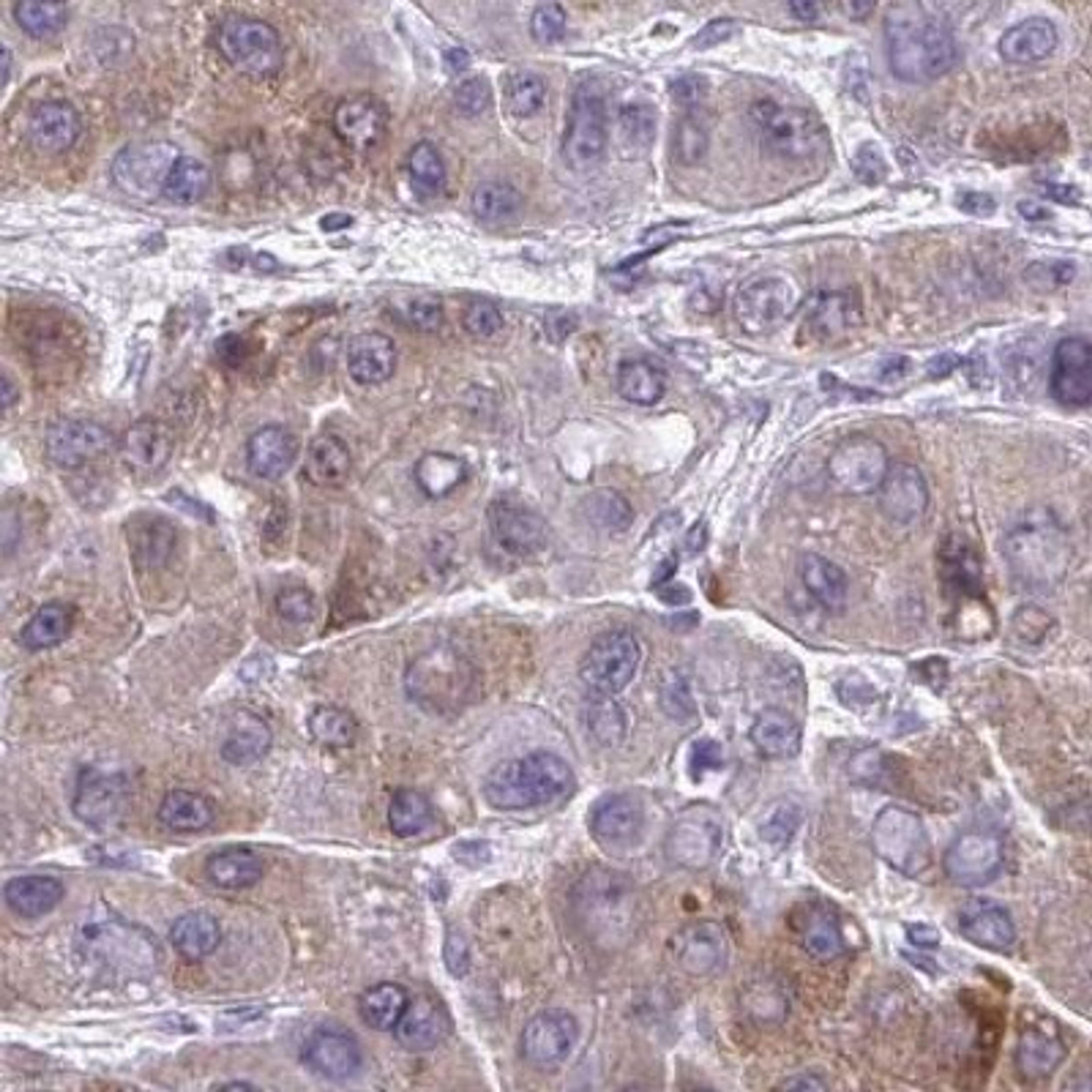 Immunohistochemistry: TMEM170A Antibody [NBP2-31593] - liver cancer