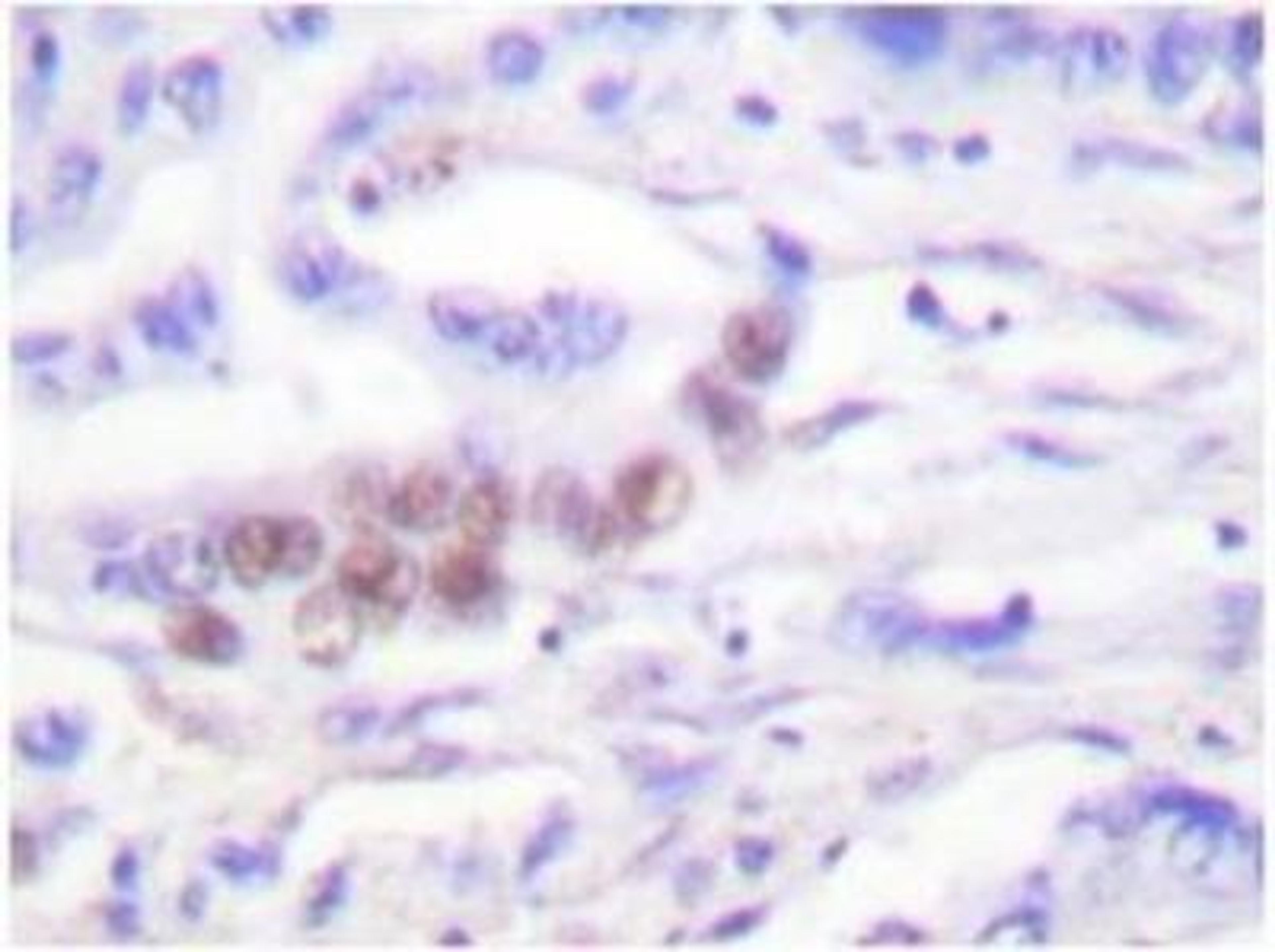 Immunohistochemistry-Paraffin: CEBP Beta Antibody [NB100-91681] - Immunohistochemistry (IHC) analyzes of C/EBP-beta (S229/182) pAb in paraffin-embedded human lung carcinoma tissue.