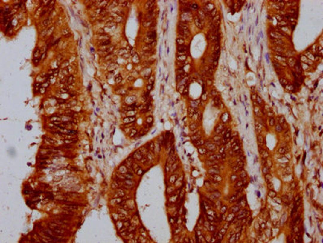 IHC image of CSB-PA010429OA88nohHU diluted at 1:10 and staining in paraffin-embedded human colon cancer performed on a Leica BondTM system. After dewaxing and hydration, antigen retrieval was mediated by high pressure in a citrate buffer (pH 6.0). Section was blocked with 10% normal goat serum 30min at RT. Then primary antibody (1% BSA) was incubated at 4&deg;C overnight. The primary is detected by a biotinylated secondary antibody and visualized using an HRP conjugated SP system.