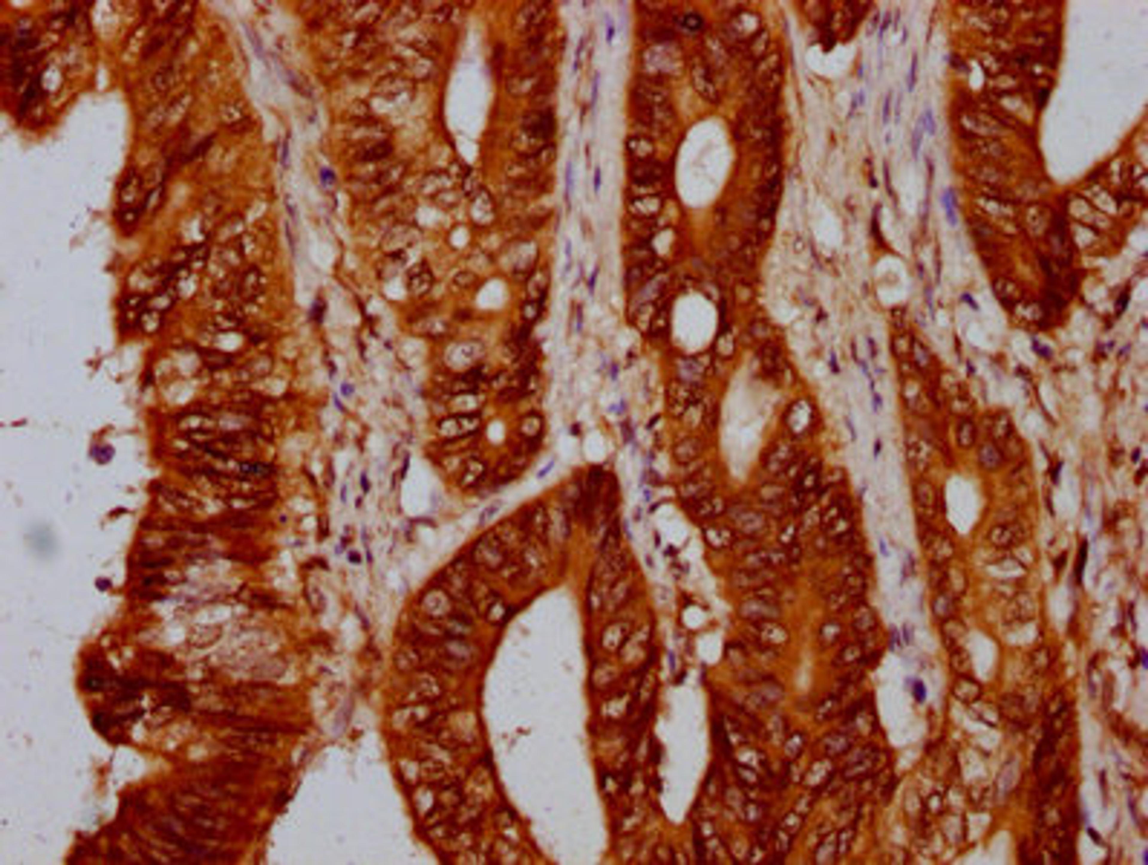 IHC image of CSB-PA010429OA88nohHU diluted at 1:10 and staining in paraffin-embedded human colon cancer performed on a Leica BondTM system. After dewaxing and hydration, antigen retrieval was mediated by high pressure in a citrate buffer (pH 6.0). Section was blocked with 10% normal goat serum 30min at RT. Then primary antibody (1% BSA) was incubated at 4&deg;C overnight. The primary is detected by a biotinylated secondary antibody and visualized using an HRP conjugated SP system.