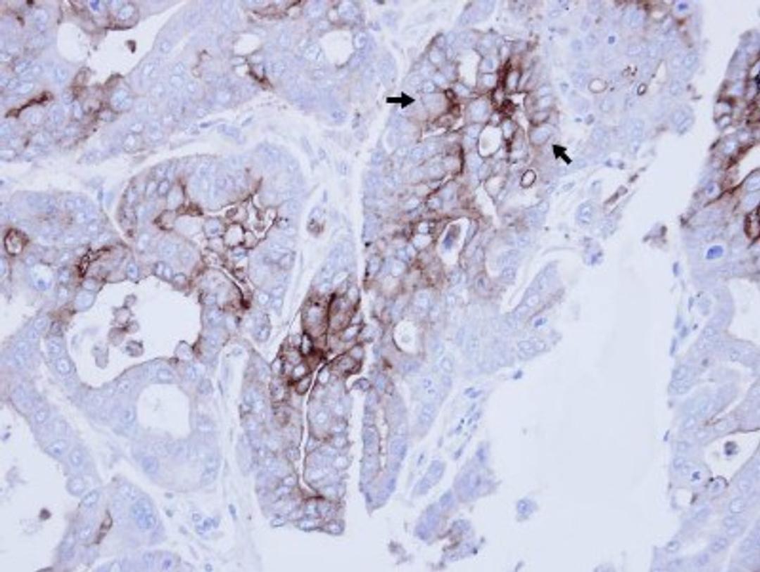 Immunohistochemistry-Paraffin: CEACAM6 Antibody [NBP2-15854] - Immunohistochemical analysis of paraffin-embedded NCIN87 xenograft , using antibody at 1:100 dilution.