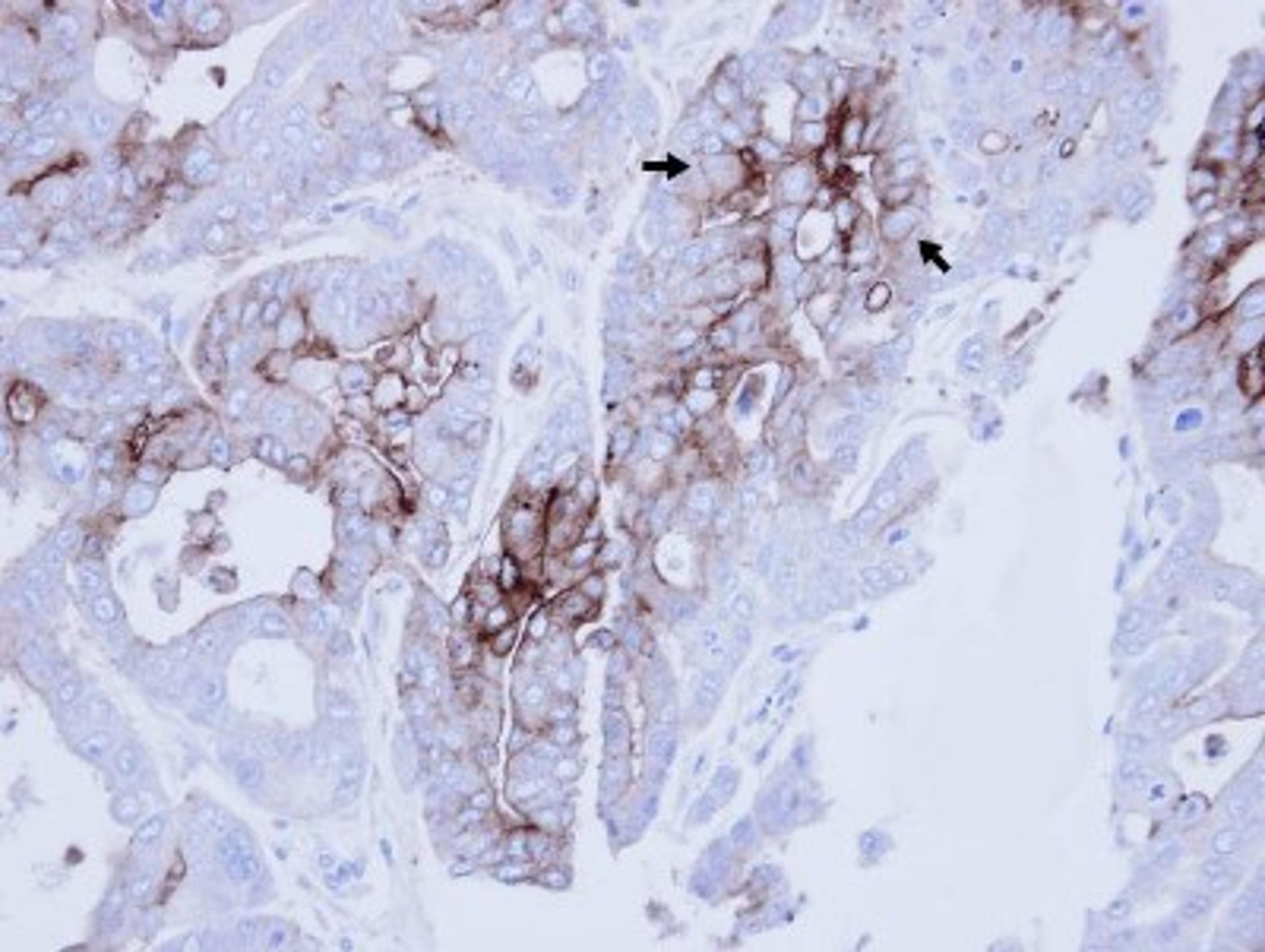 Immunohistochemistry-Paraffin: CEACAM6 Antibody [NBP2-15854] - Immunohistochemical analysis of paraffin-embedded NCIN87 xenograft , using antibody at 1:100 dilution.